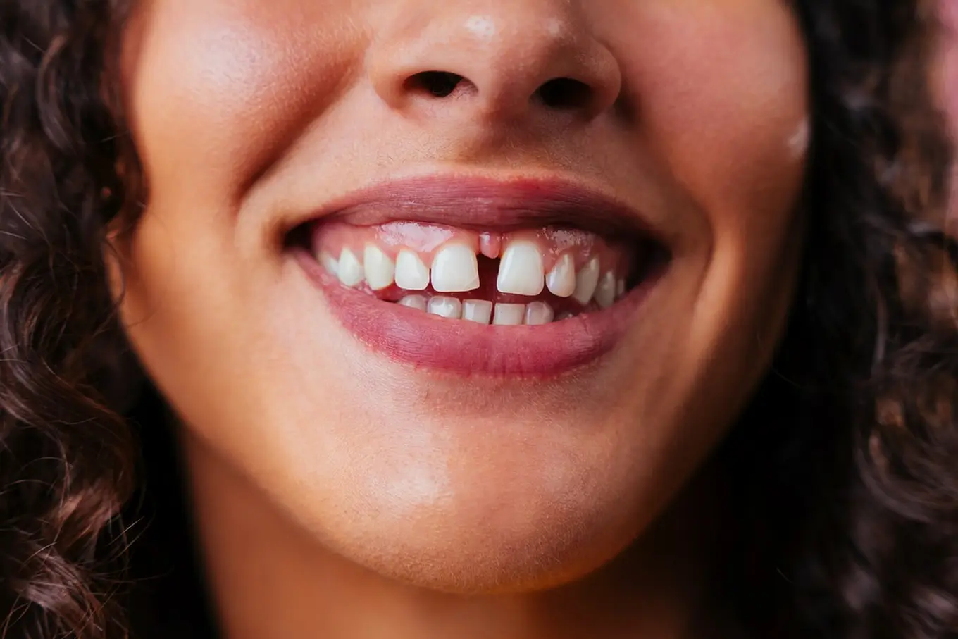 diastema